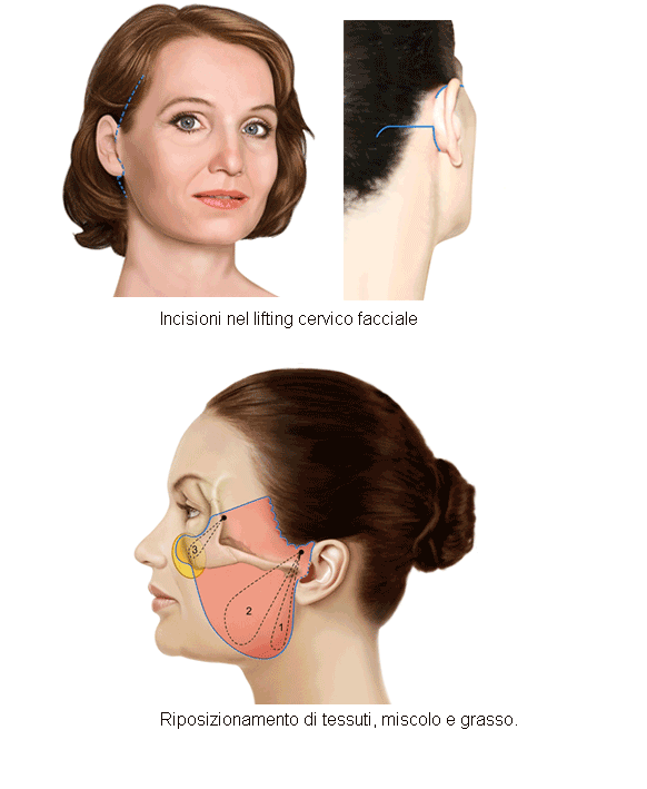 Lifting cervico-facciale
