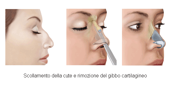 Rinoplastica - Chirurgia del naso